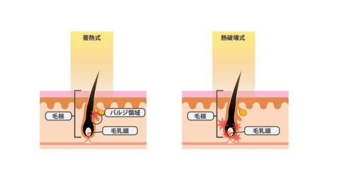 医療脱毛クリニックの脱毛方式